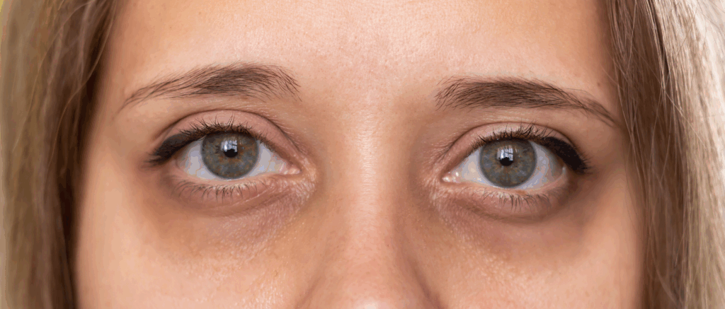 cernes sous les yeux