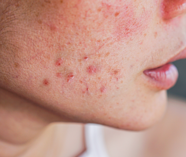 acne